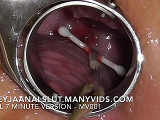 Amateur Freyjaanalslut：彼女のIUDを削除する -  Freyjaの子宮頸部から引き離し、再び彼女の肥沃なものを作ります - 多くのversidsのフルバージョン